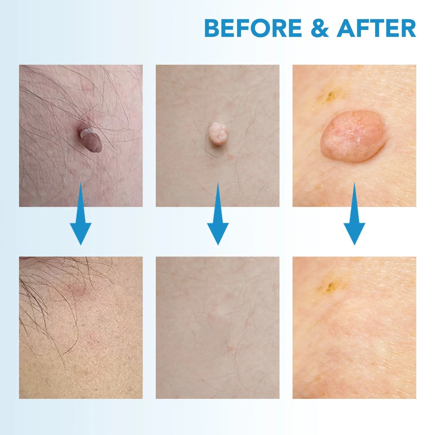 Auto Skin Tag Remover Kit